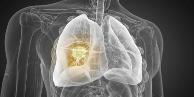 X-ray of lungs