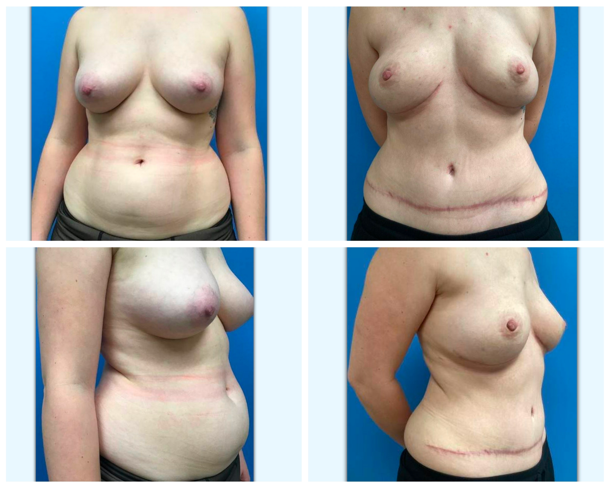 Before and after breast reconstruction