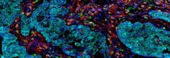 Tumor image
