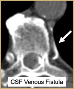 CSF Venous Fistula