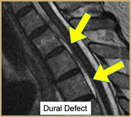 Dural Defect