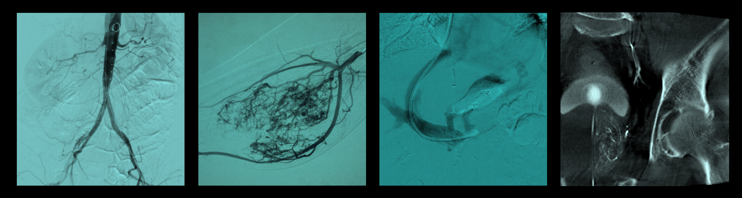 Interventional Radiology Interventional Radiology