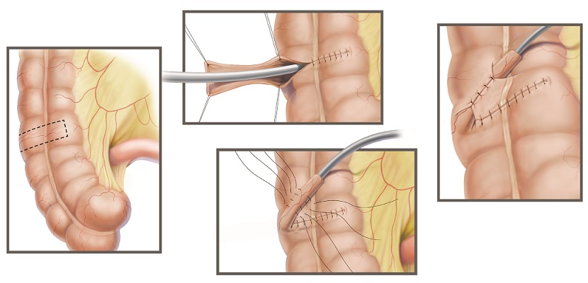 Colorectal handout-03