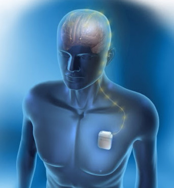 deep brain stimulation update november 2013 Deep brain stimulation