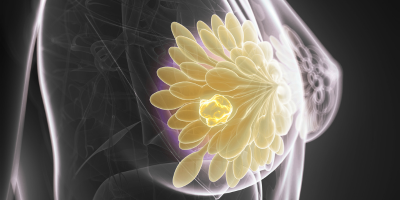 X-ray Breast Cancer