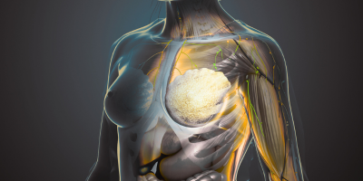 Lobular cancer breast x ray