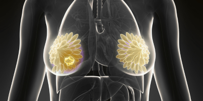 xray of breast cancer