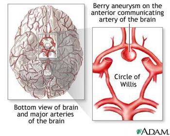 Aneurysm