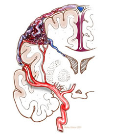 AVM depiction