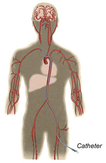 Endovascular Catheterization Endovascular Catheterization