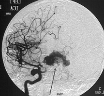 Tangled Blood Vessels