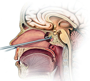 Graphic showing placement of pituitary gland in the head Graphic showing placement of pituitary gland in the head