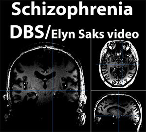 schizophrenia dbs image