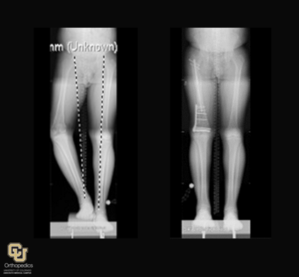 limb deformity