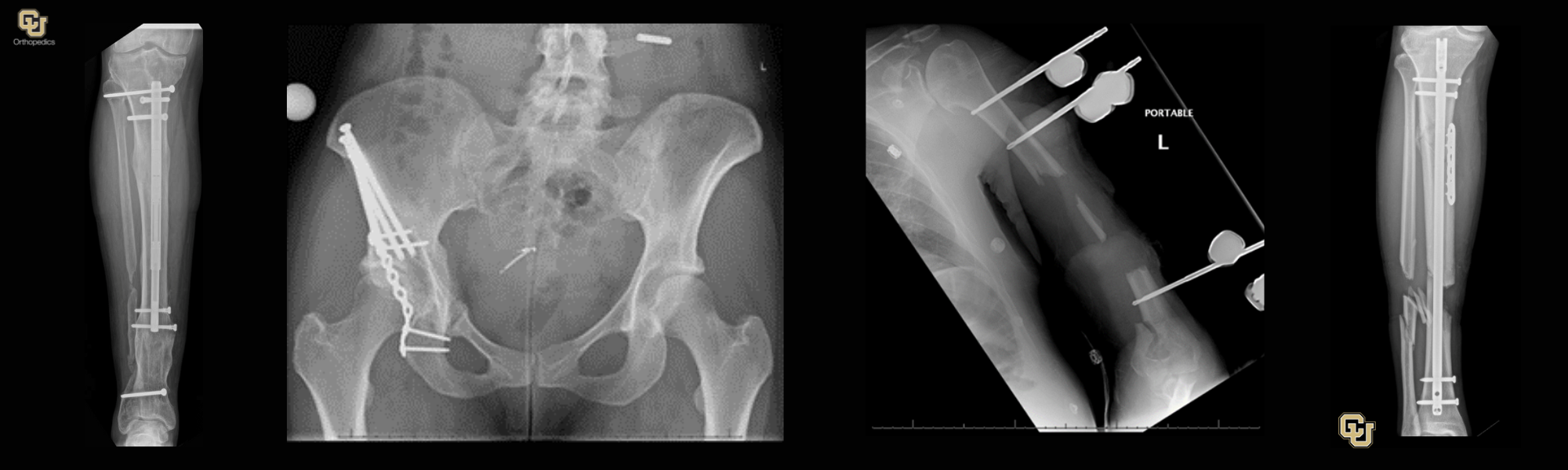 University of Colorado, Limb Deformities, Conditions We Treat