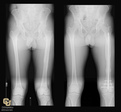 What is a Bone or Fracture Malunion