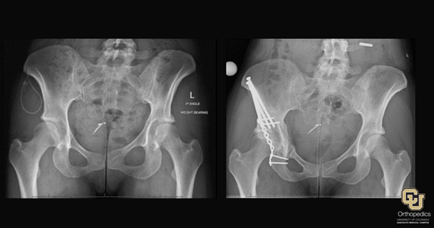 bone-malunions---nonunions
