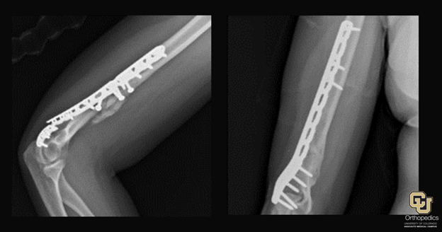 bone-malunions---nonunions