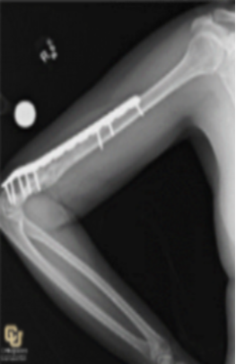 Bone Malunions or Bone Nonunions