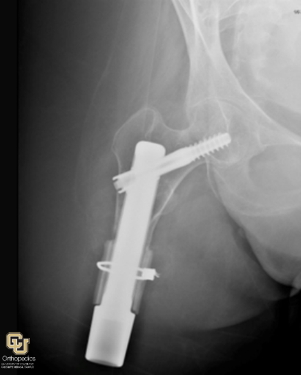 Amputation and Osseointegration Surgery in Amputees