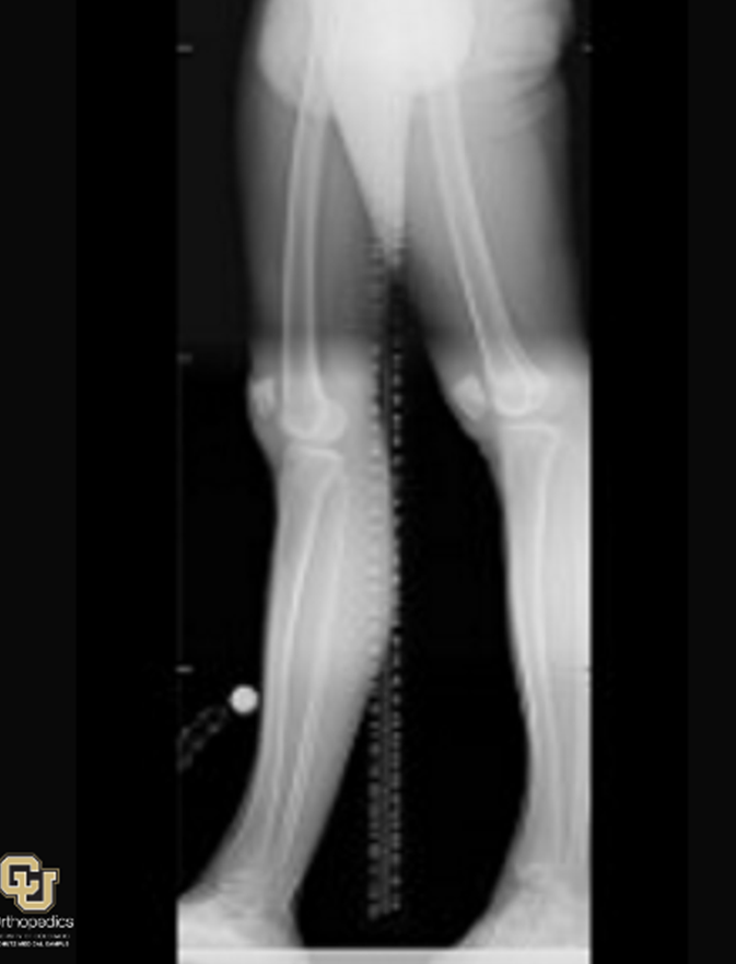 Bone or Limb Deformities