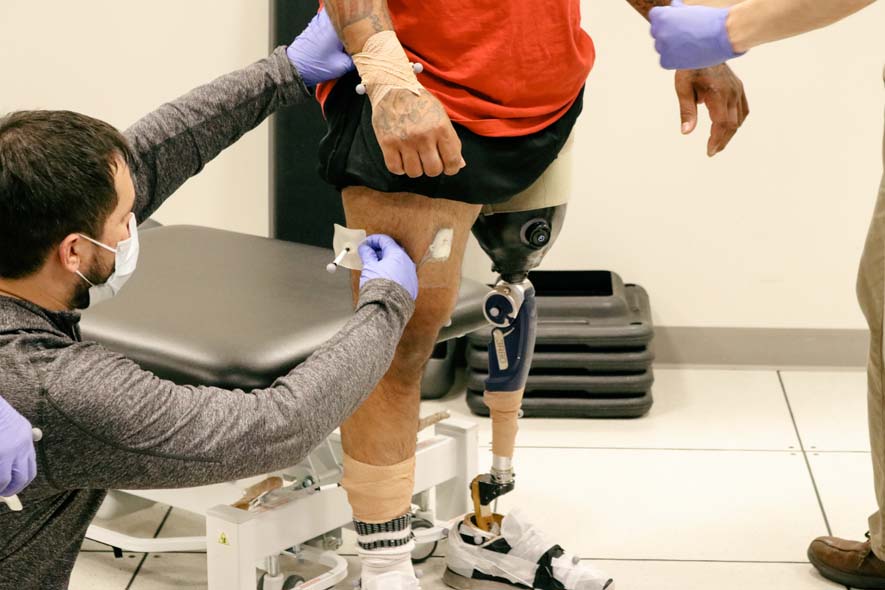 University Colorado Osseointegration Prosthetic Stoneback