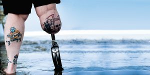 Osseointegration, A Game Changer for Amputee's