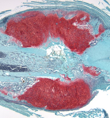 Impact of obesity on the skeleton