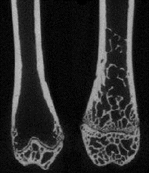 Identifying genes that regulate response of bone to PTH