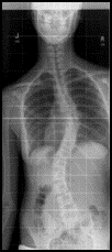 Functional Models of Idiopathic Scoliosis