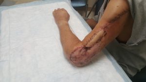 Saving an Arm with the Help of a Leg
