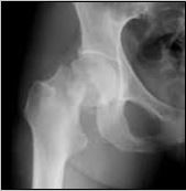 Geriatric Hip Fracture Program