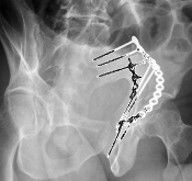 Pelvic fracture 2