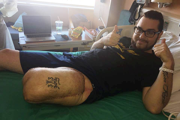 Limb Restoration_Denver