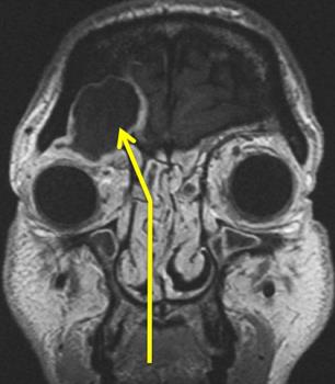 Transnasal Approach 2 Transnasal Approach 2