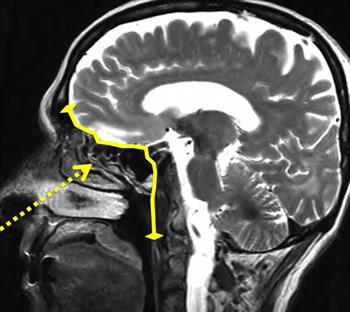 Transnasal Approach Transnasal Approach