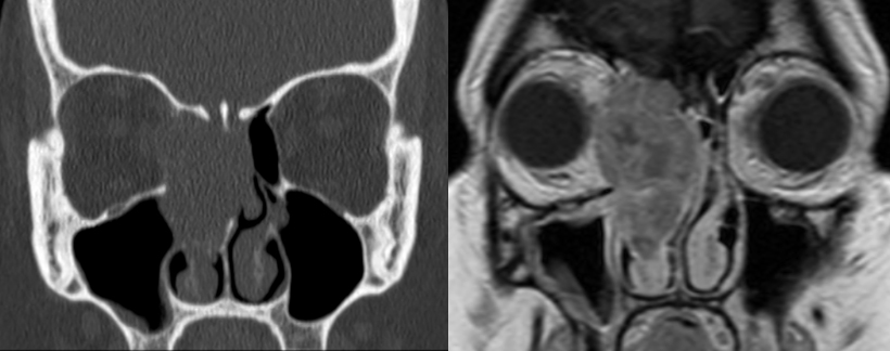 Tumor MRI Tumor MRI