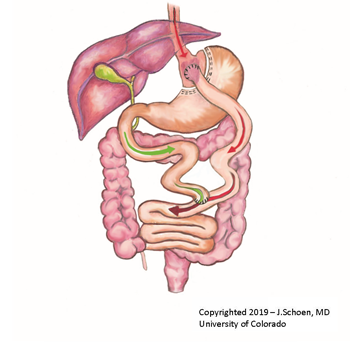 Gastric Bypass Gastric Bypass