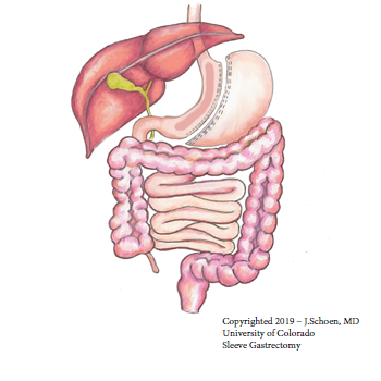 Gastric Sleeve Gastric Sleeve