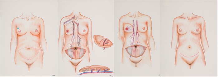 DIEP Flap
