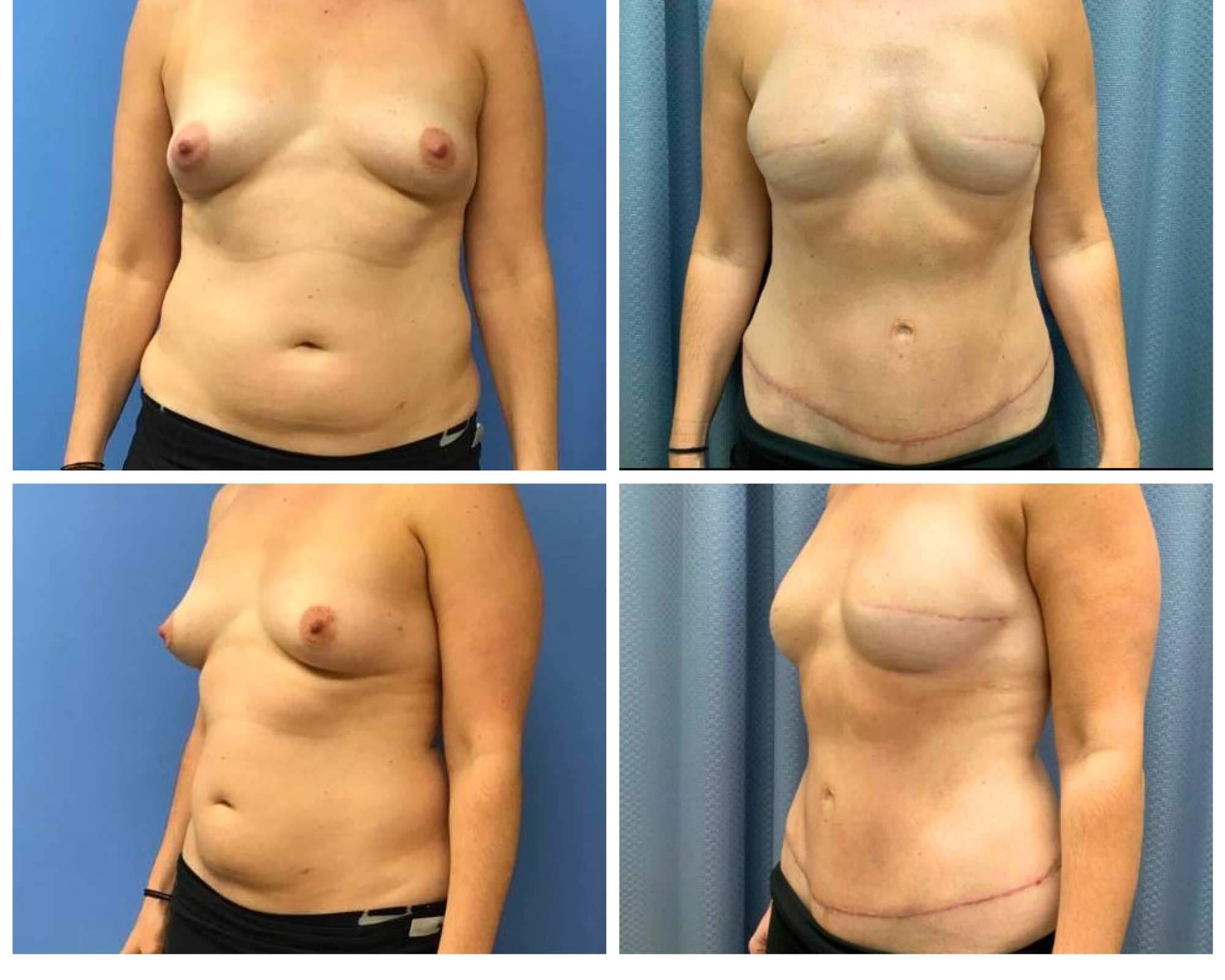 DIEP Flap skin sparing mastectomy
