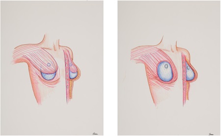 Post-Mastectomy Breast Implant Post-Mastectomy Breast Implant