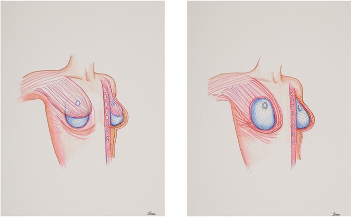 Implant-based reconstruction model Post-Mastectomy Breast Implant