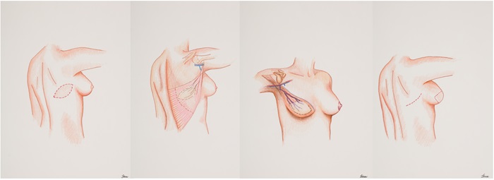 Latissimus
