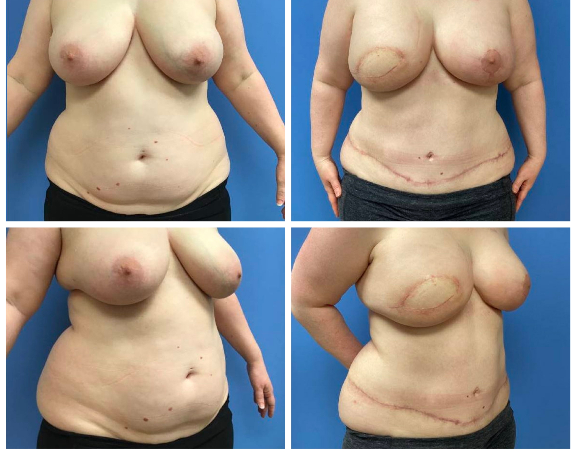 DIEP flap reconstruction right side