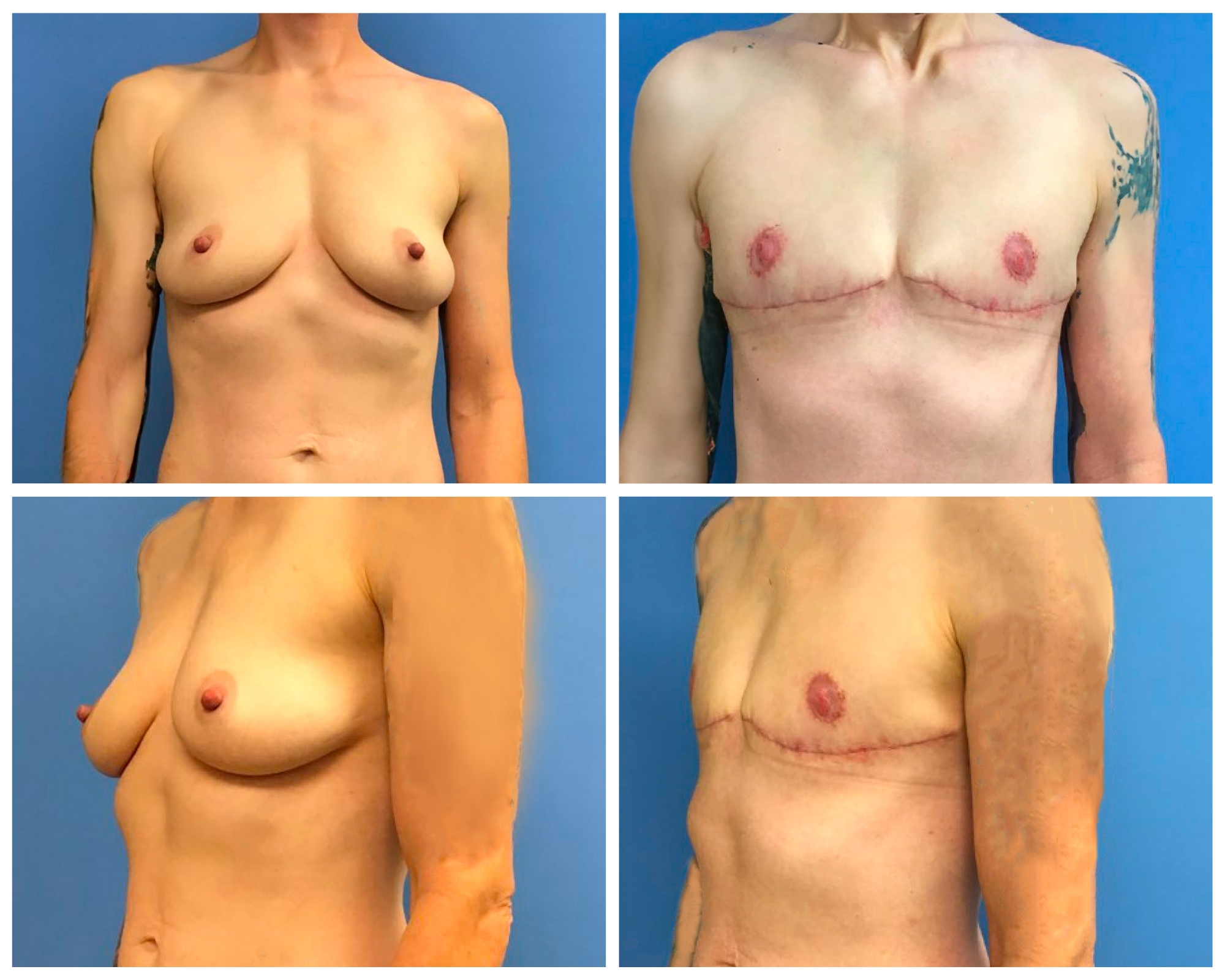 FTM Top Surgery Before and After 1