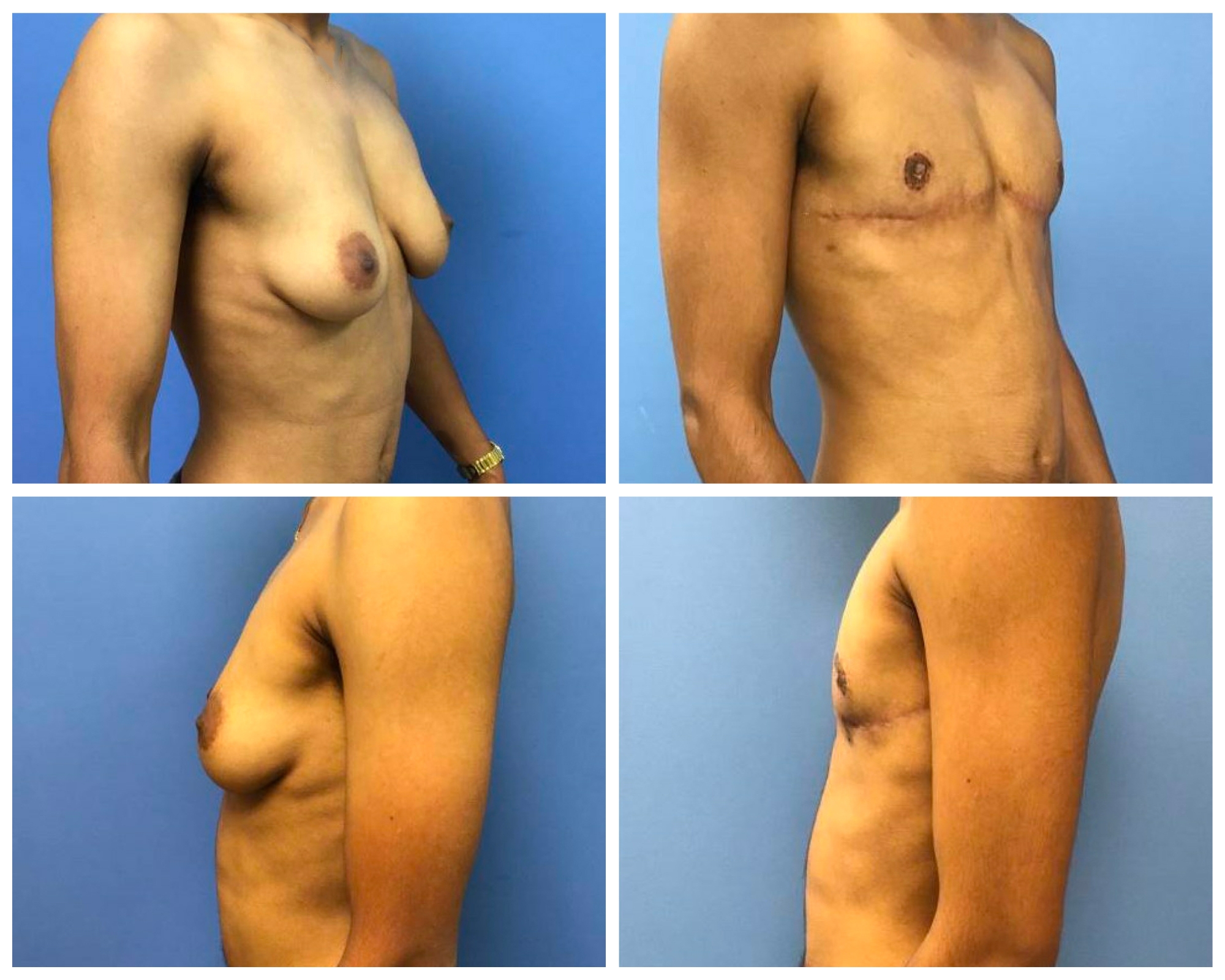 FTM Top Surgery Patient 2