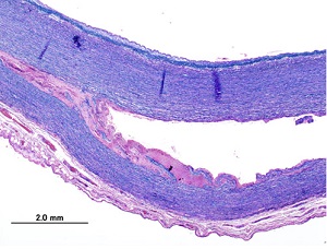 Aortic Dissection Microscope Image