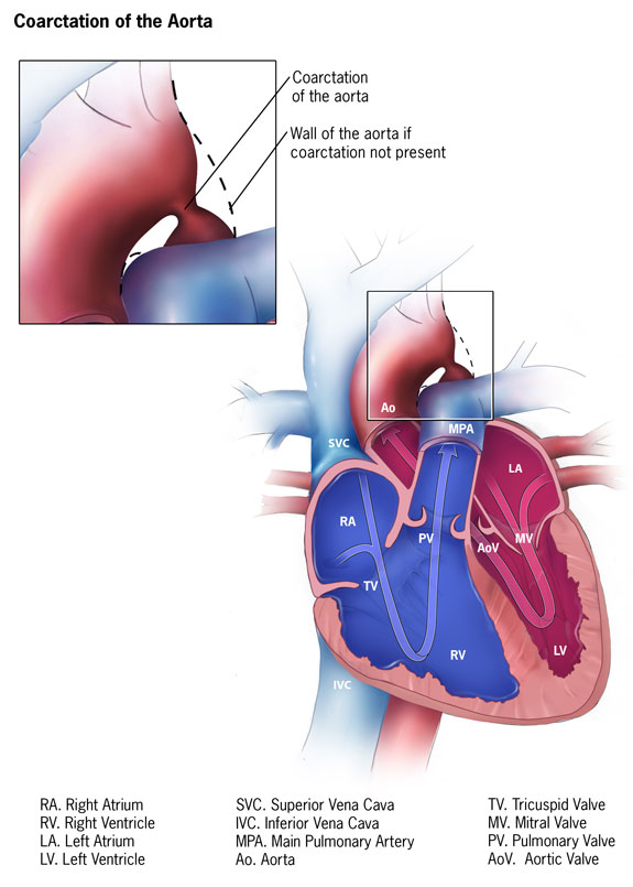 Coarctation of the Aorta -- 575 x 805 Diagram: Coarctation of the Aorta