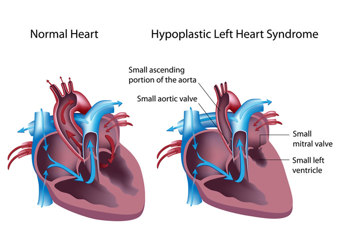 hypoplastic-left-heart-syndrome -- 675 x 499 Hypoplastic Left Heart Syndrome
